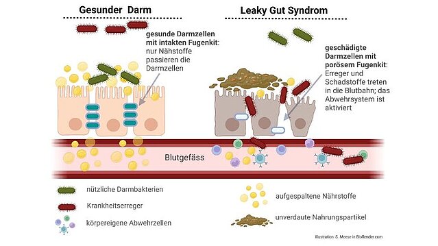 Leaky Gut Syndrom